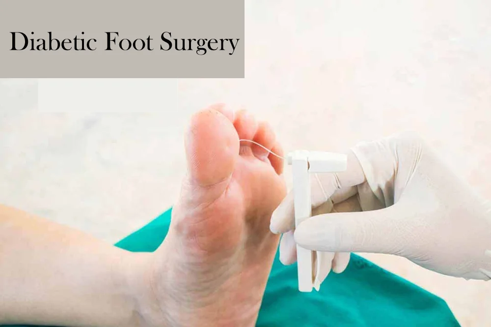 Diabetic Foot Surgery
