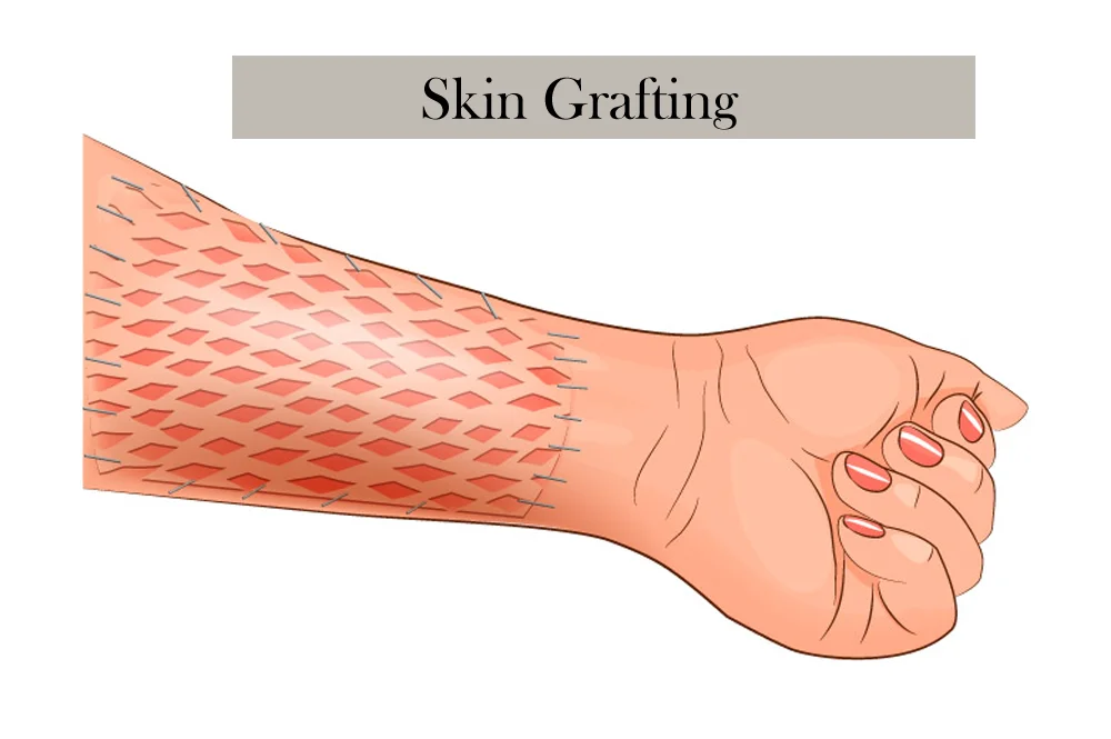 Skin Grafting