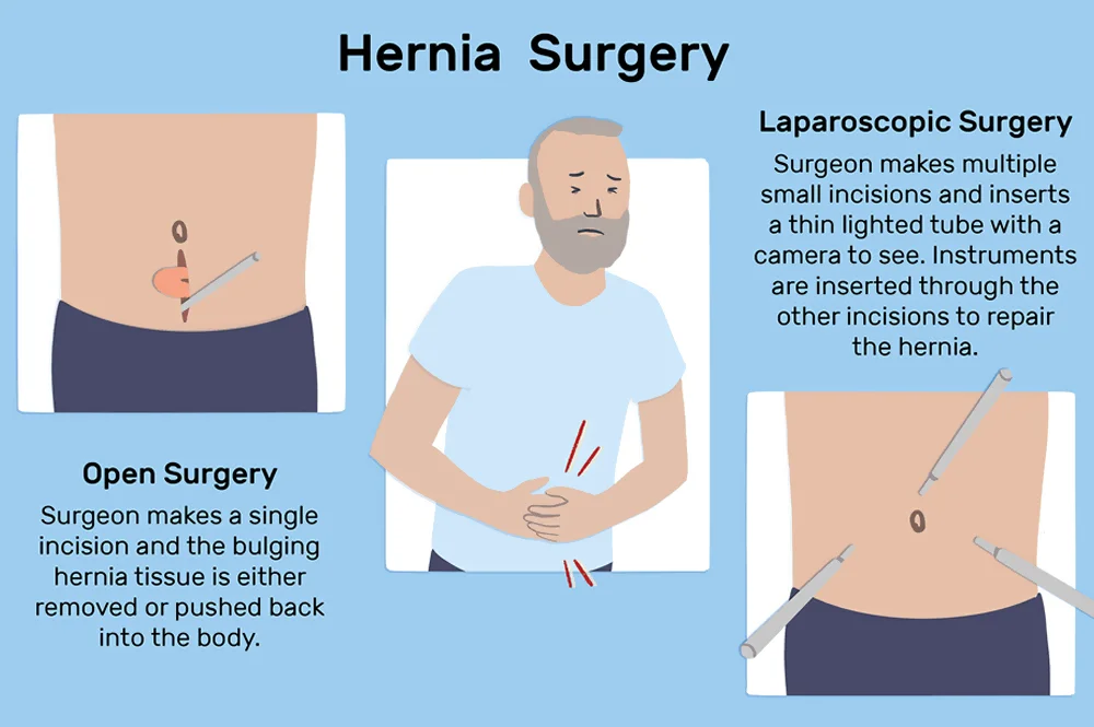 Hernia Surgery