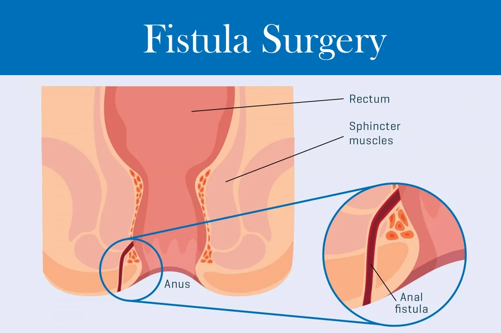 Fistula Surgery