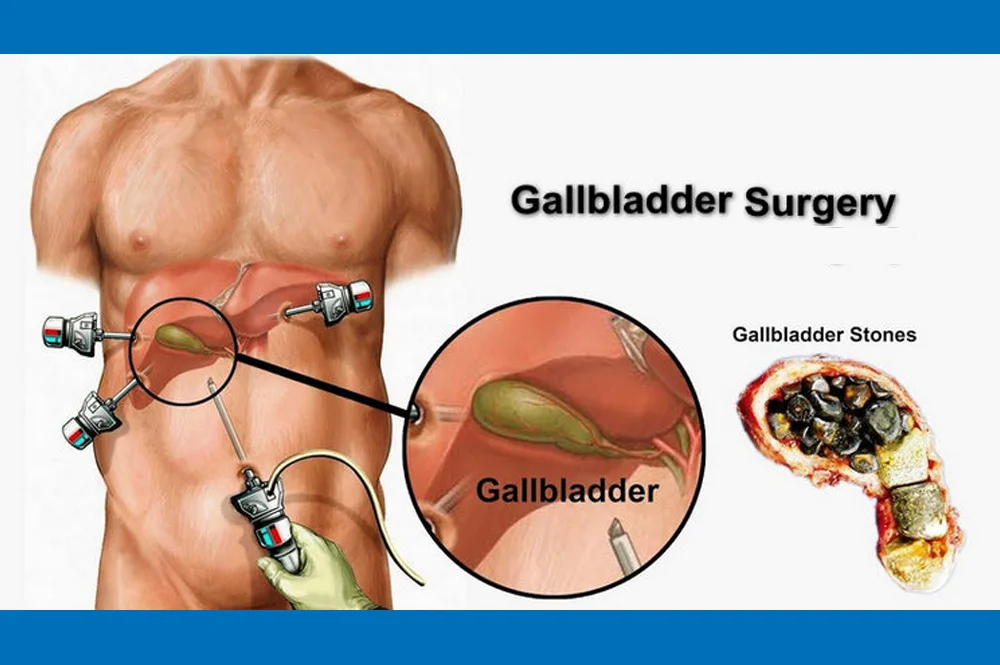 Gallbladder Surgery