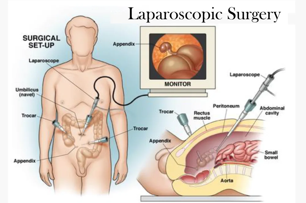 Laparoscopic Surgery