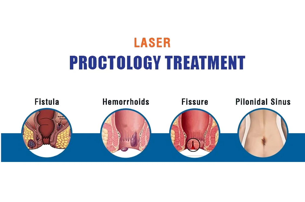 Laser Proctology